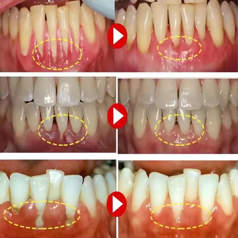 Żel do wybielania zębów, pielę – Teeth Whitening Gels recenzja i cena