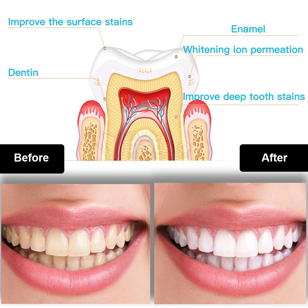 Zestaw do wybielania zębów den – Teeth Whitening Gels recenzja i cena